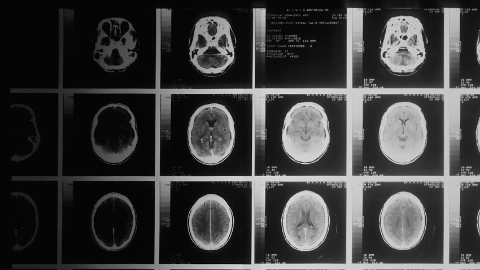 Plus Therapeutics’ REYOBIQ™ Shows Clinical Benefit and Safety in the ReSPECT-LM Clinical Trial for Patients with Leptomeningeal Metastases (LM)