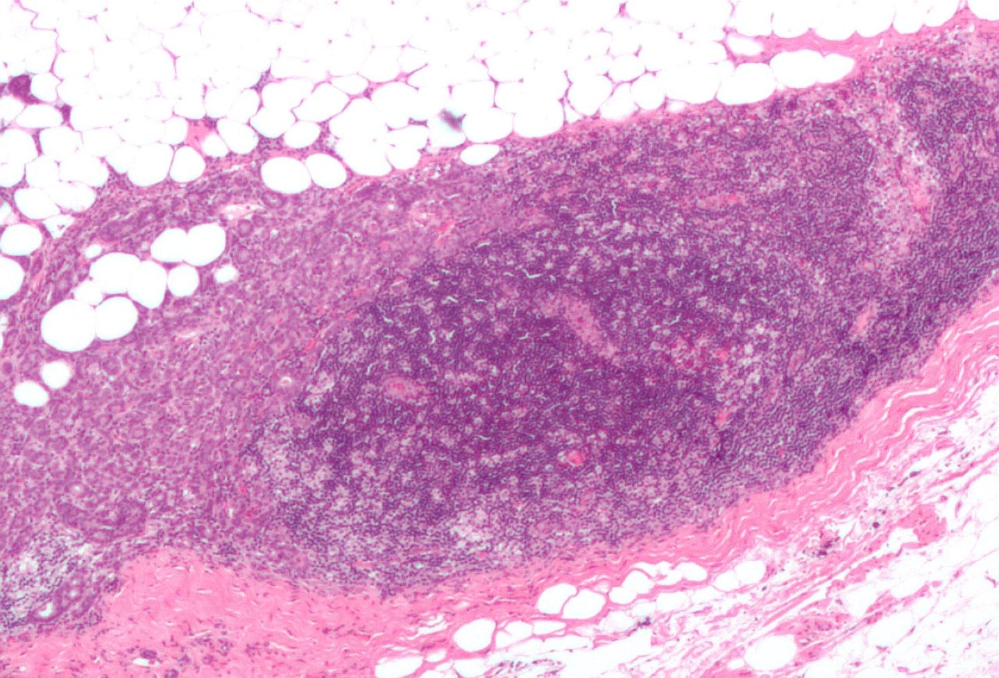 China approves AstraZeneca-Daiichi Sankyo’s breast cancer therapy