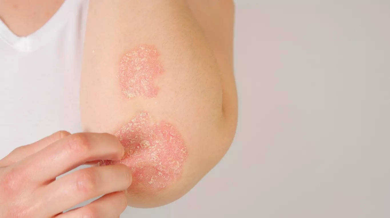 New hope for chronic hand eczema patients: Tofacitinib clinical trial shows 90% improvement