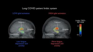 Brain inflammation is unlikely to explain persistent long COVID symptoms