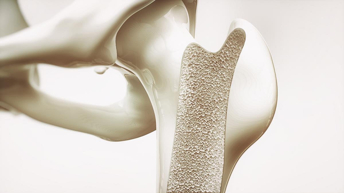 AAOS: GLP-1 Receptor Agonist Use Increases Five-Year Risk for Osteoporosis