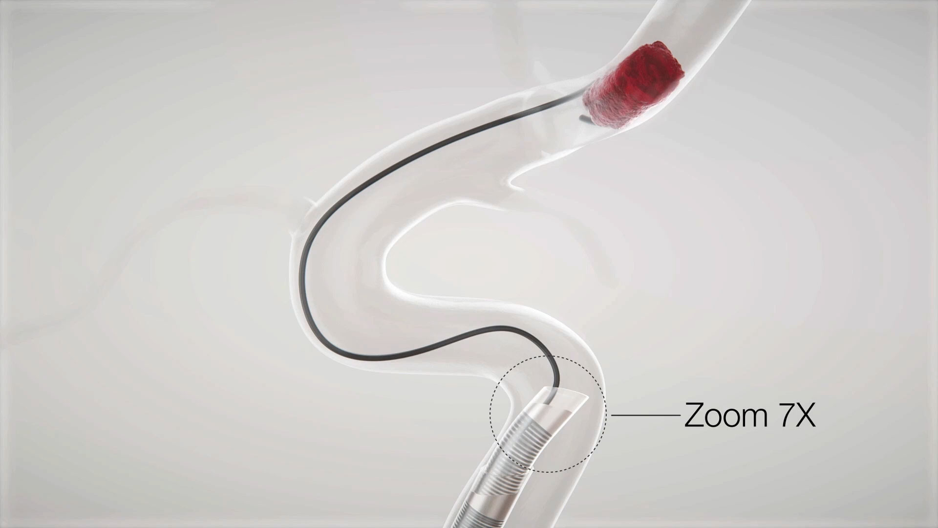 Imperative Care Secures FDA Clearance and Initial Cases of the Zoom 7X Catheter, the Newest Innovation in Ischemic Stroke Treatment