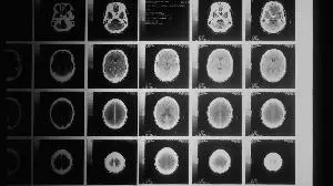 Curasight Announces Preliminary Readout from its Phase 1 Clinical Trial with uTREAT® in Aggressive Brain Cancer (Glioblastoma)