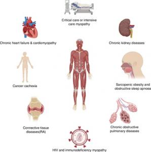 Rheumatoid Arthritis and Muscle Wasting: New Review Points to Overlooked Complications
