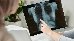 GRI Bio’s GRI-0621 Demonstrates Encouraging Safety Results at Planned Interim 6-Week Analysis in Ongoing Phase 2a Study in Idiopathic Pulmonary Fibrosis (“IPF”)