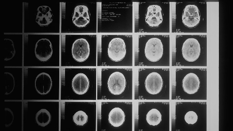 Radiopharm Theranostics Doses First Patient with 18F-RAD101 in U.S. Phase 2b Imaging Study of Brain Metastasis