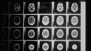 SL Science Holding Limited Submits Orphan Drug Designation Request to the U.S. FDA for GDT Cell Therapy Targeting Glioblastoma