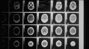NKGen Biotech To Present on Potential of Troculeucel for the Treatment of Neurodegenerative Diseases at the 13th Annual Alzheimer’s & Parkinson’s Drug Development Summit