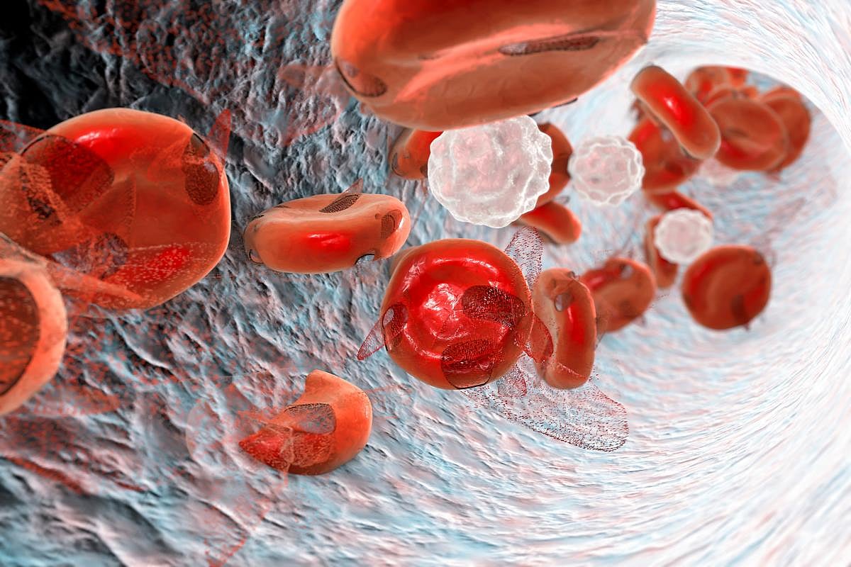 IV Iron Dextran Cost-Effective for Managing Iron-Deficiency Anemia