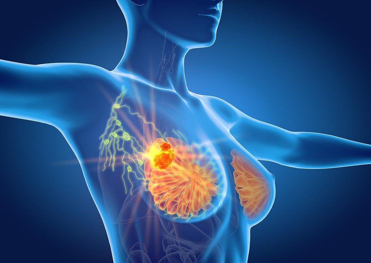EBCC: Axillary Radiotherapy Without Lymphadenectomy Feasible for Breast Cancer