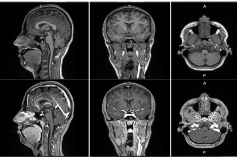GE HealthCare Announces First Patient Dosed in Phase 2/3 LUMINA Trial for Manganese-Based MRI Contrast Agent Under FDA Fast Track Designation, Further Advancing Its Innovation Pipeline of Novel Imaging Agents
