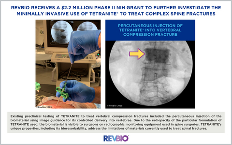 RevBio Receives a $2.2 Million Phase II NIH Grant to Further Develop the Minimally Invasive Use of TETRANITE ®  to Treat Complex Spine Fractures