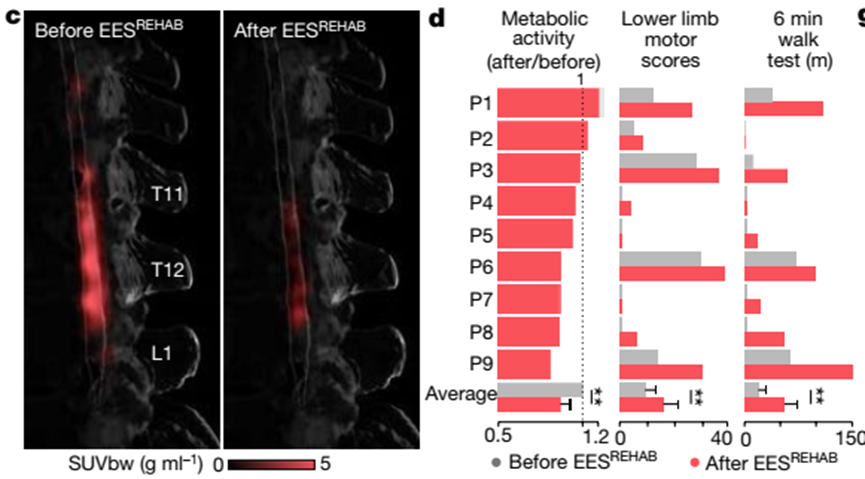 《自然》重磅：让瘫痪者再次行走，这项神奇技术只要5个月！