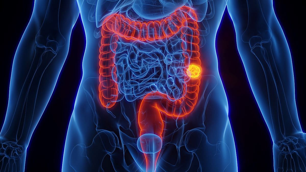Colorectal Cancer Incidence, Mortality Increasing Among Under 65s