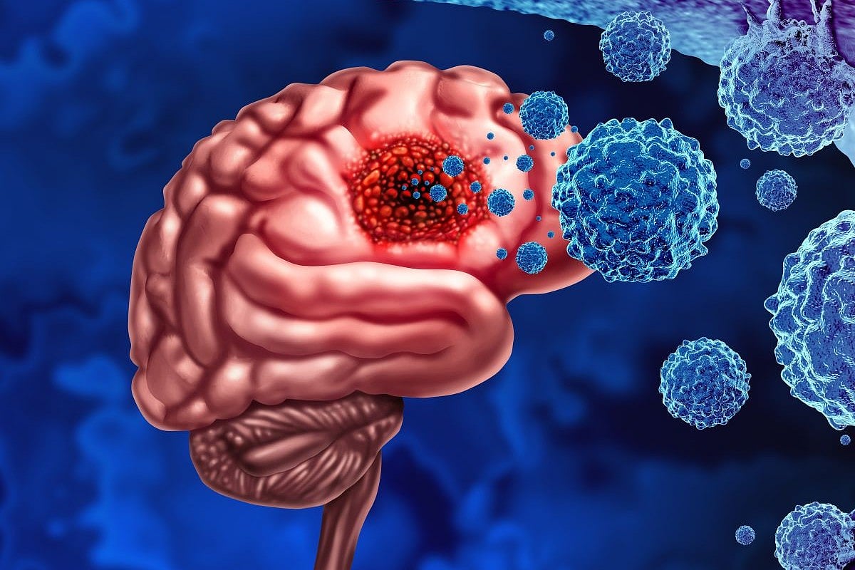 Stereotactic Radiation Improves Brain Metastases Symptoms, Interference With Daily Functioning