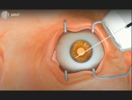 Sanoculis Receives CE Mark Approval for MINT Glaucoma Surgery Device in EU