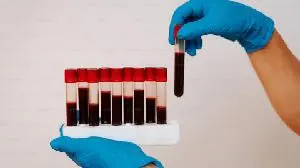 Study Results of Orelabrutinib in Patients with SLE Published in the Journal of Autoimmunity