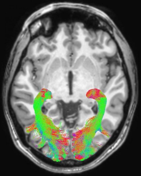 Herantis taps Indivi for digital biomarker tech in Parkinson’s disease trial