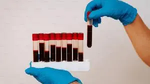 ORYZON Receives European Medicines Agency Approval to Initiate a Phase Ib Study of Iadademstat in Sickle Cell Disease