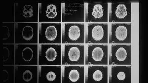 Anavex Life Sciences Provides Regulatory Update on Blarcamesine for Early Alzheimer's Disease