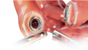 Promising Results in First-in-Human Study, Self-Forming Magnets for Compression Anastomosis in Colorectal Surgery