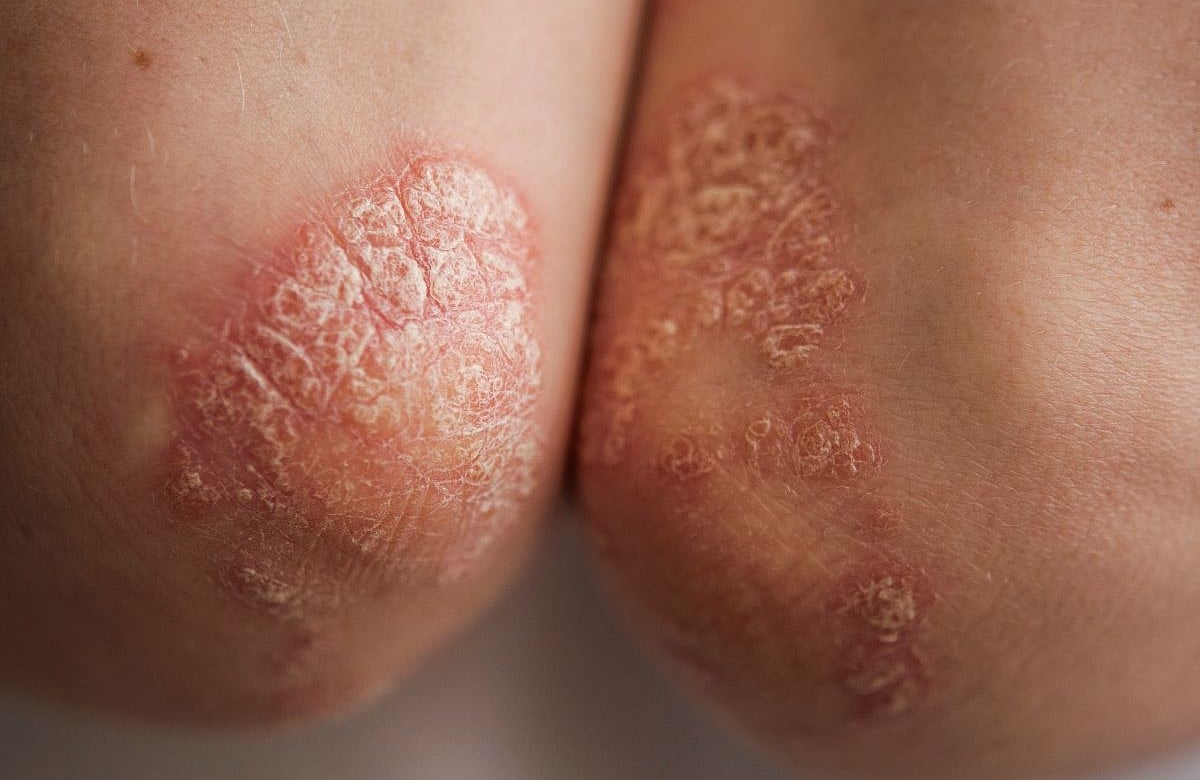 New Pill Could Change Plaque Psoriasis Treatment