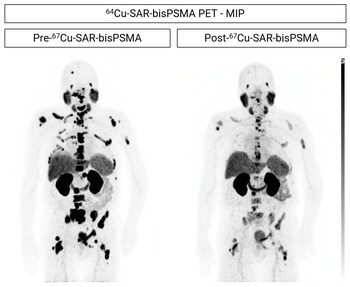 Clarity's theranostic prostate cancer trial advances to multi-dose phase