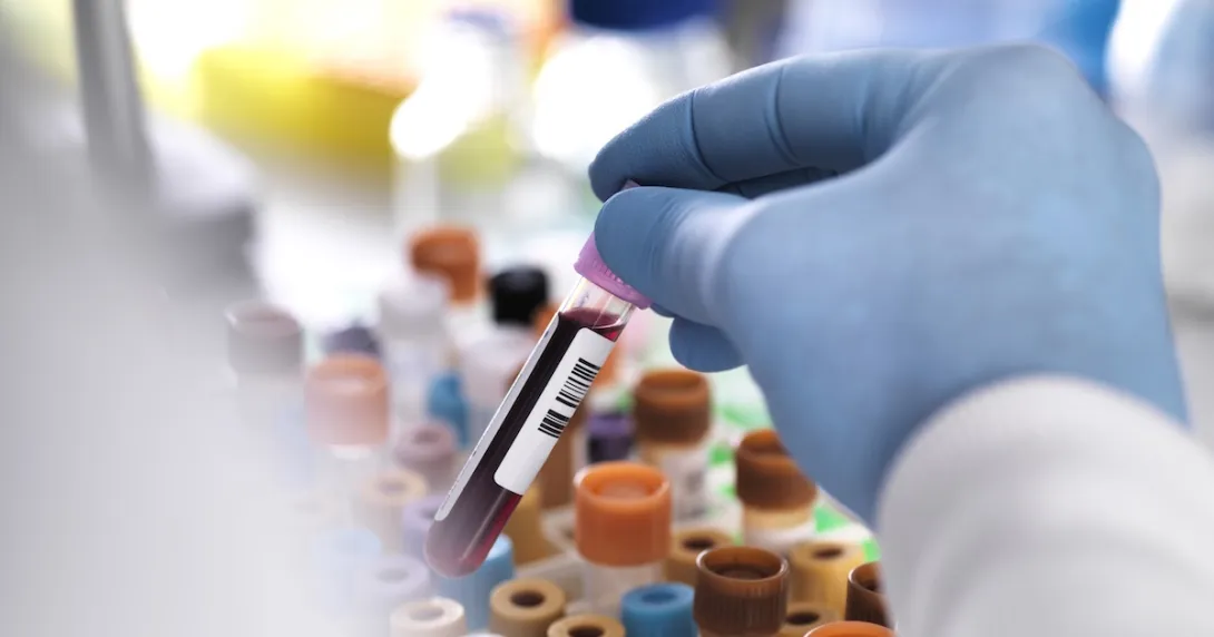 National Taiwan University Hospital develops AI for pancreatic cancer metabolic profiling