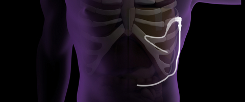 CMS Grants HCPCS Code and NTAP Classification for Pleural Dynamics’ Novel ACES Automatic Continuous Effusion Shunt