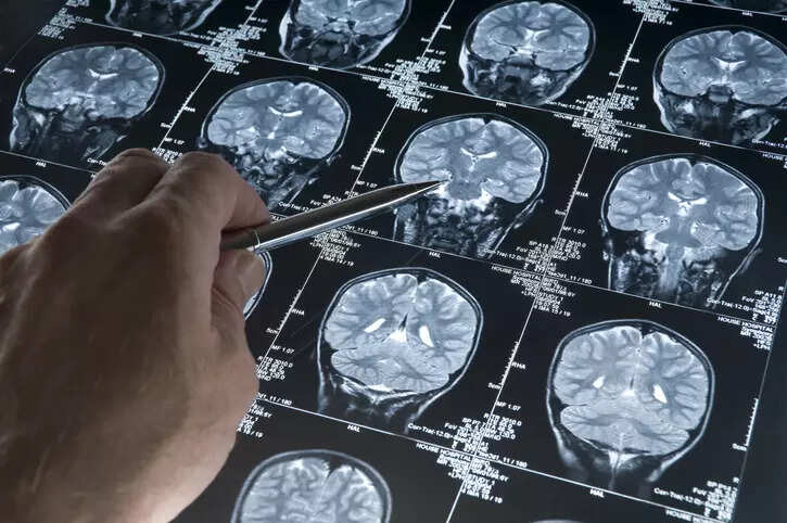 INmune Bio's Alzheimer's drug falls short of mid-stage study goal, shares tumble