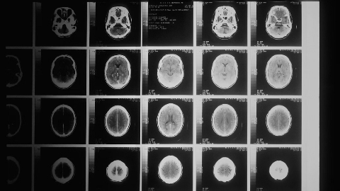 Plus Therapeutics Announces FDA Clearance of its Investigational New Drug Application using REYOBIQTM for the Treatment of Childhood Brain Cancer