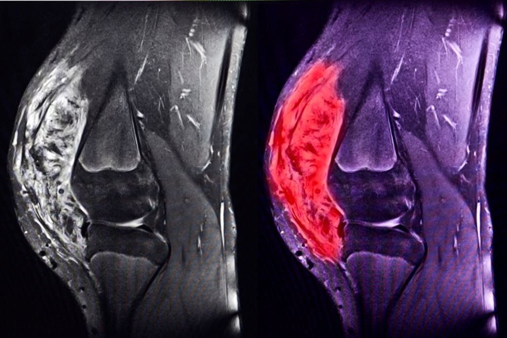 FDA signs off on Adaptimmune's Tecelra as the first engineered cell therapy for a solid tumor