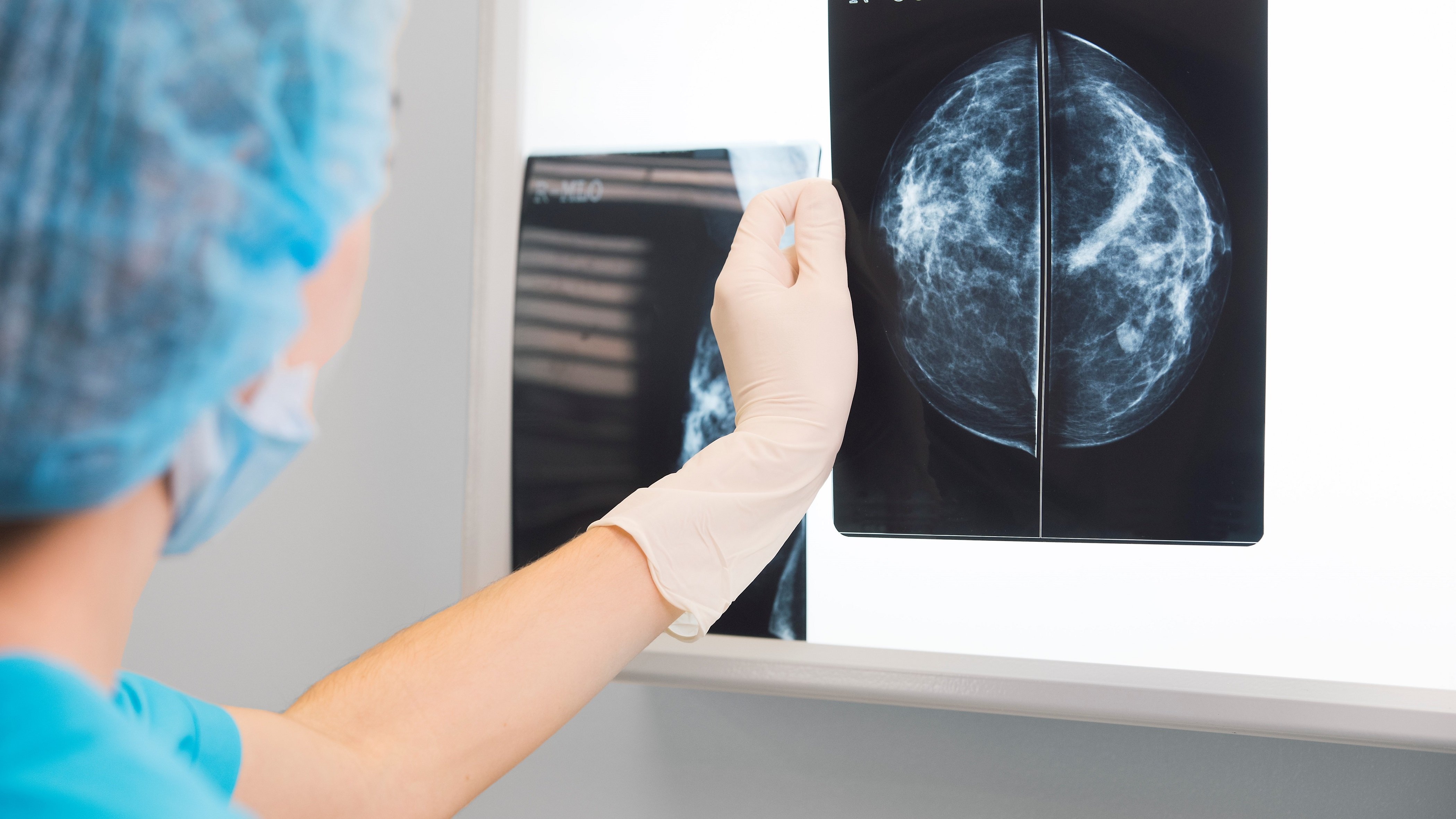 RadNet to absorb mammography AI developer iCad in $103M deal