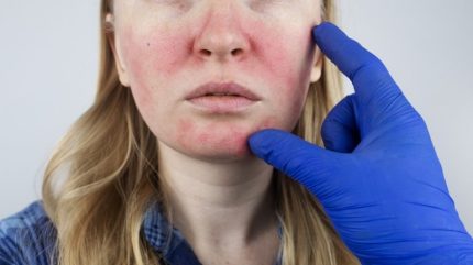 FDA approves Journey Medical’s rosacea treatment Emrosi