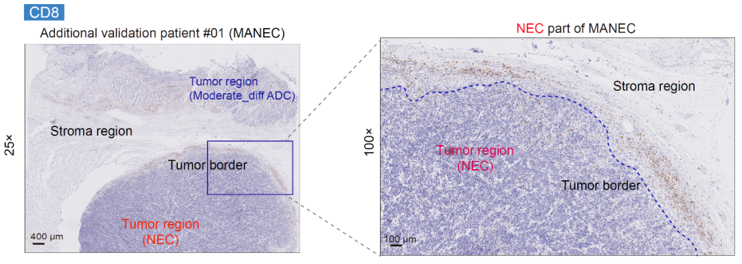 NSR：汤富酬团队揭示胃癌肿瘤异质性及不同分化状态的关键分子特征