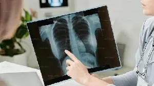 Avalyn Announces Upcoming Presentation on its Lead Program AP01, Inhaled Pirfenidone, for the Treatment of Pulmonary Fibrosis at the European Congress of Rheumatology 2025
