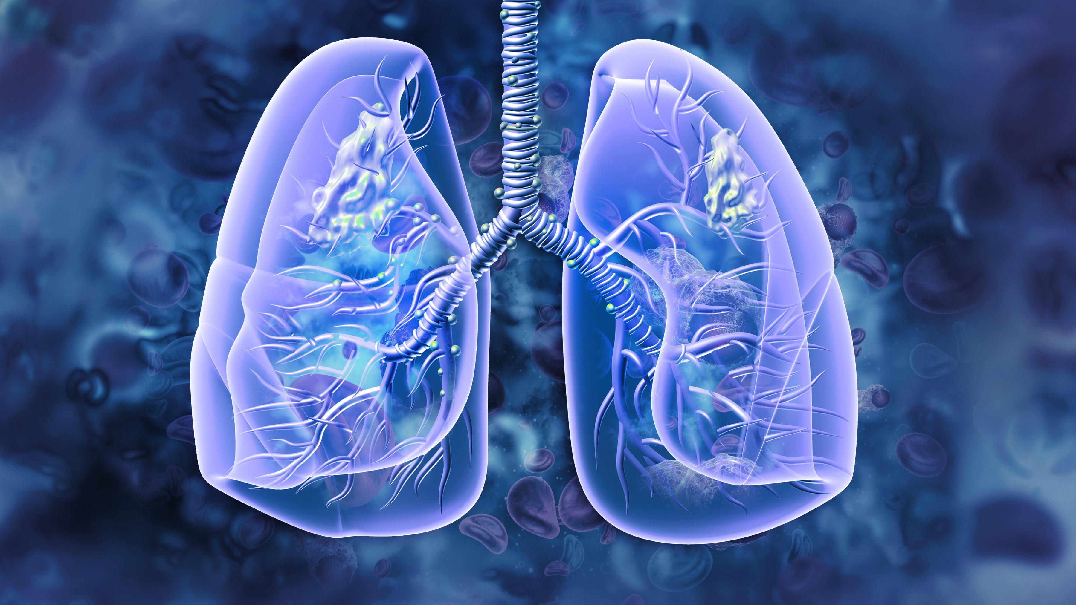 OS Therapies\' HER2 drug prevented lung cancer from returning in a 3rd of patients