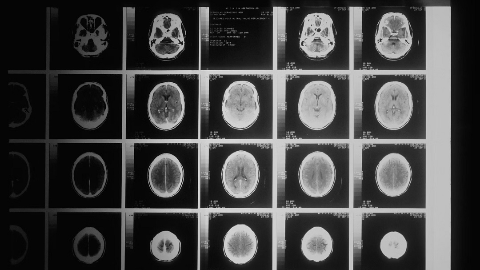 Cognition Therapeutics' Positive Clinical Data from Zervimesine (CT1812) Phase 2 Study in Dementia with Lewy Bodies (DLB) will be Presented in a Podium Presentation at AAIC