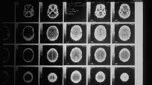 Cognition Therapeutics' Positive Clinical Data from Zervimesine (CT1812) Phase 2 Study in Dementia with Lewy Bodies (DLB) will be Presented in a Podium Presentation at AAIC