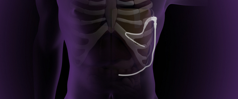 Study Demonstrates Significant Reduction in Pleural Effusion Volume Using Pleural Dynamics’ ACES Fully-Implantable System