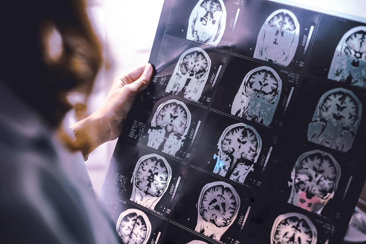 Diabetes Drugs, Jardiance and Insulin Nasal Spray, Might Counter Brain Decline In Early Alzheimer's Patients