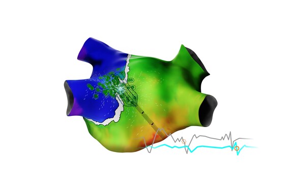 Biosense Webster Launches New Version of CARTO™ 3 Electro-Anatomical Mapping System