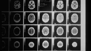 MerryLife Biomedical Reports Positive Phase 1 Results and Plans for Global Phase 2 Trial for TML-6, an Oral Multi-Targeted Investigational Therapy for Alzheimer's Disease
