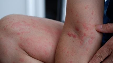 FDA reviews Sanofi and Regeneron’s Dupixent label expansion for urticaria