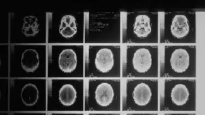 Cognition Therapeutics Presents Data at AAIC Highlighting Broad Neurological Impact of Zervimesine (CT1812) in Dementia with Lewy Bodies and Alzheimer’s Disease