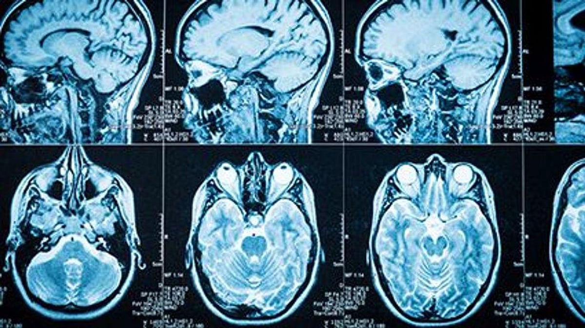 Different Types of Brain Tumors: What They Are, How They Present and What To Expect