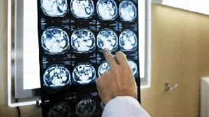 Novartis Fabhalta® (iptacopan) meets Phase III primary endpoint, slows kidney function decline in patients with IgA nephropathy (IgAN)