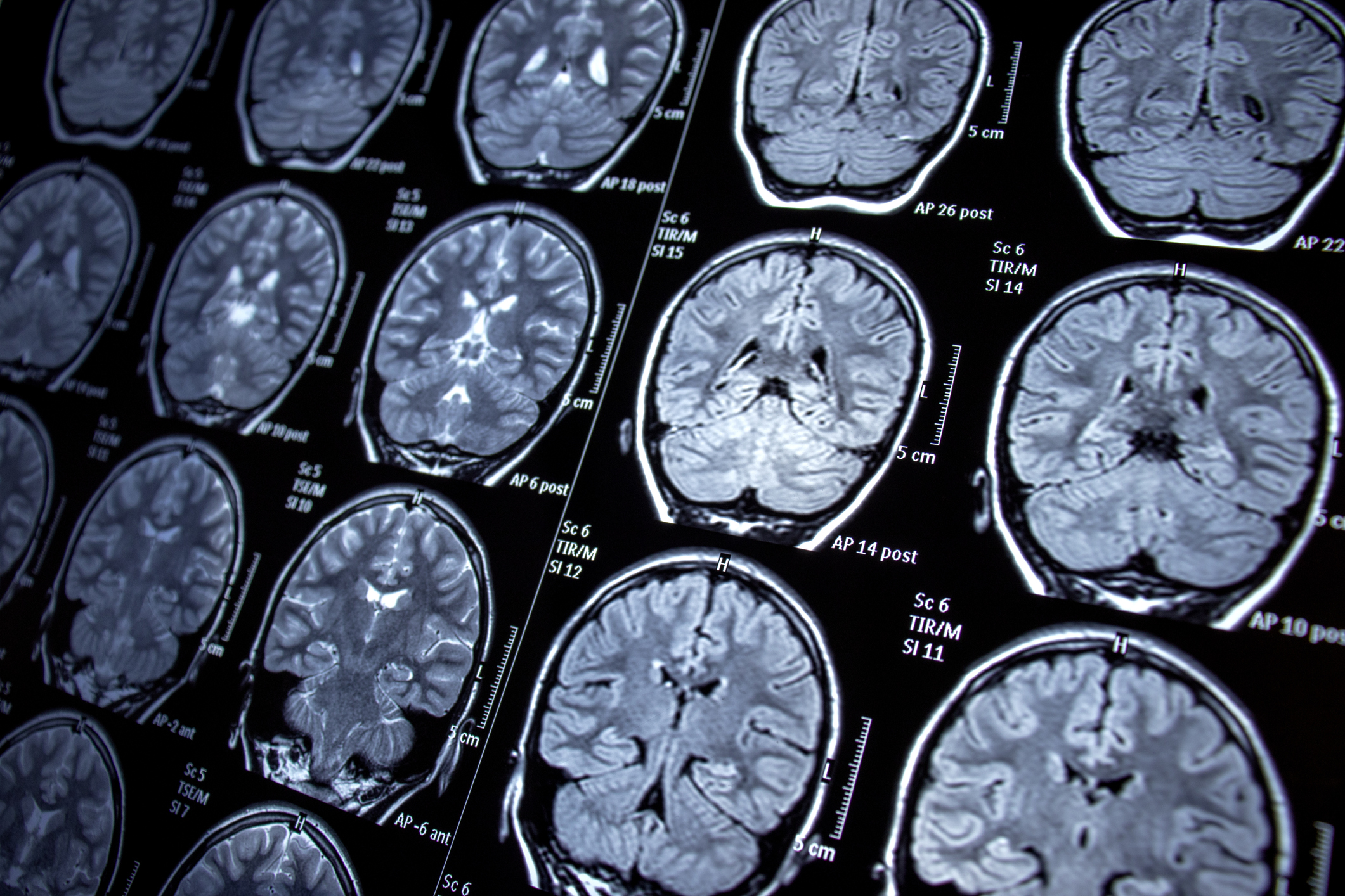 Clario continues acquisition spree with imaging specialist NeuroRx