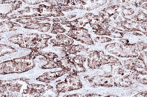 Roche's VENTANA PD-L1 (SP263) test gains CE label expansion as a companion diagnostic to identify non-small cell lung cancer patients eligible for Tecentriq