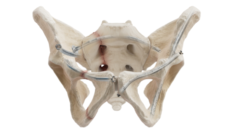 CurvaFix Expands National Market Access - Awarded Technology Breakthrough Designation With Premier Inc. for General Orthopedic Trauma Products